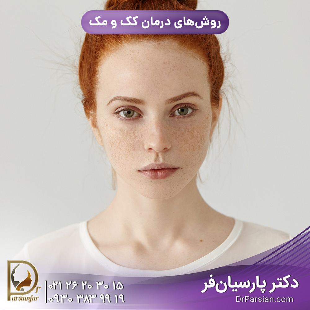 درمان کک و مک در تهران