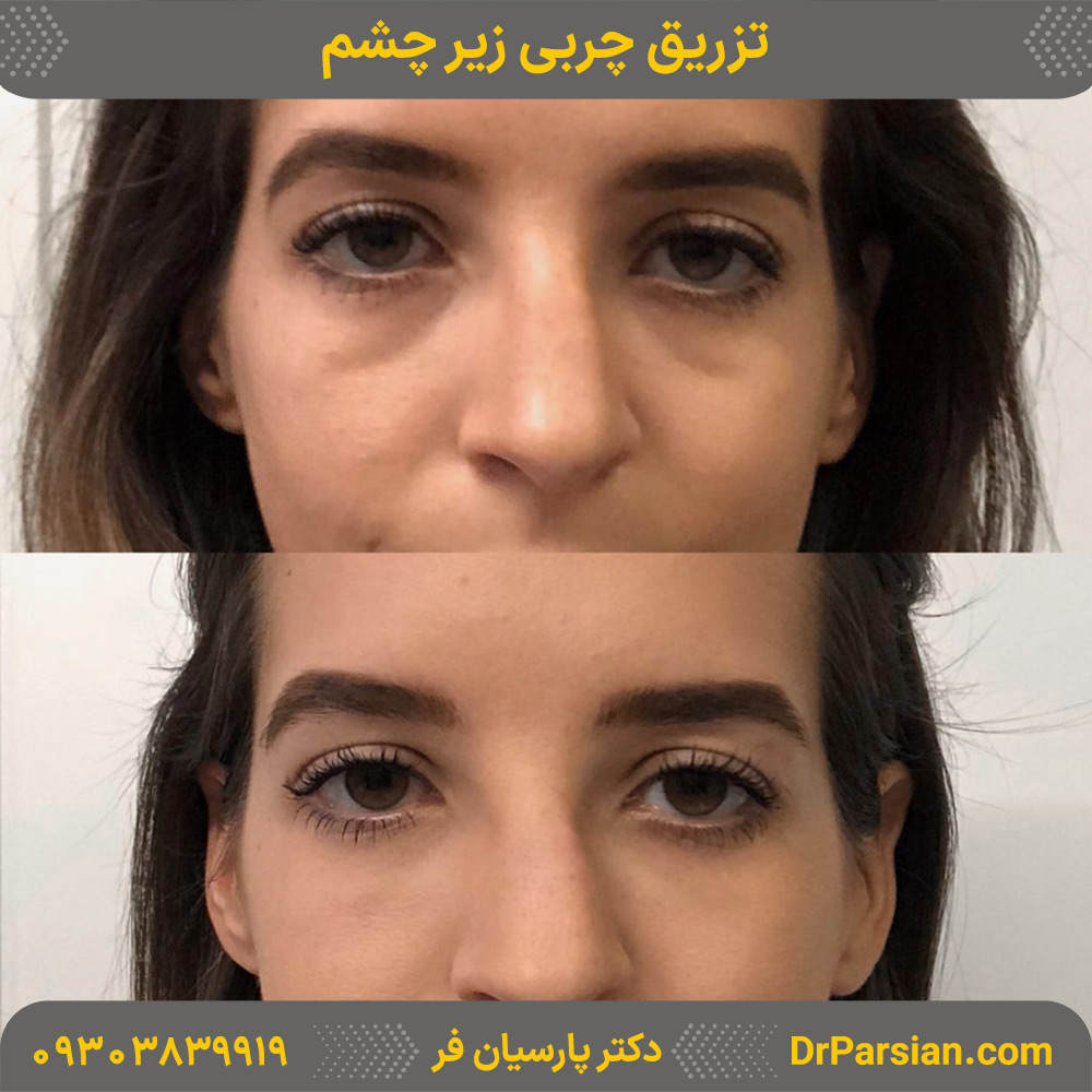 تزریق چربی زیر چشم