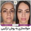 جوانسازی صورت در تهران نمونه کار 26
