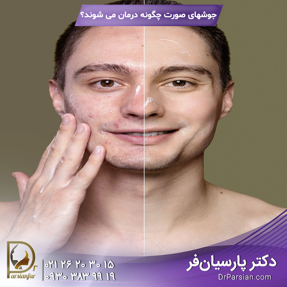 درمان انواع جوشهای صورت
