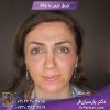 تزریق چربی به چانه در جردن تهران